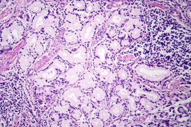 Midede mukoza kanserinin fotomikroskobu, kötü huylu muksin üreten hücreler gösteriyor, agresif mide kanserinin karakteristiği..