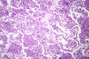 Gri hepatik evrede lobar zatürreenin fotomikrografı, akciğer dokusunda exüdate dolu alveolle geçiş olduğunu gösteriyor..