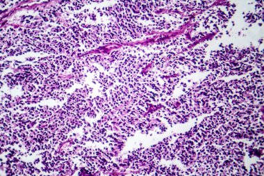 Küçük hücre akciğer kanserinin fotomikroskobu, yoğun paketlenmiş kötü huylu hücrelerin saldırgan akciğer hastalığının karakteristik özelliklerini ortaya çıkarıyor..