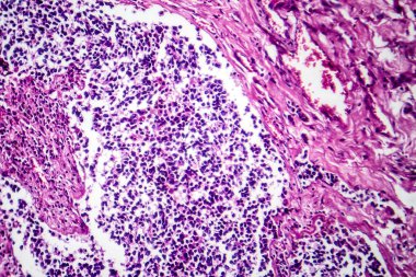 Küçük hücre akciğer kanserinin fotomikroskobu, yoğun paketlenmiş kötü huylu hücrelerin saldırgan akciğer hastalığının karakteristik özelliklerini ortaya çıkarıyor..