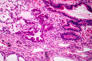 Akciğer adenokarsinomunun fotomikroskobu, en yaygın akciğer kanseri tipini gösteren kötü huylu salgı hücrelerini gösteriyor..