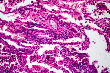 Akciğer kanseri dokusunun fotomikroskobu kötü huylu hücreleri ve akciğer hastalığının anormal büyüme özelliklerini ortaya çıkarıyor..
