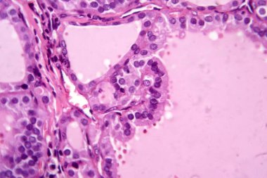 Toksik bir guatr doku örneğinin mikroskop altında fotokopisi tiroid foliküler hücrelerin hipertrofini, artan vasküleriteyi ve koloid tükenmesini gösteriyor..