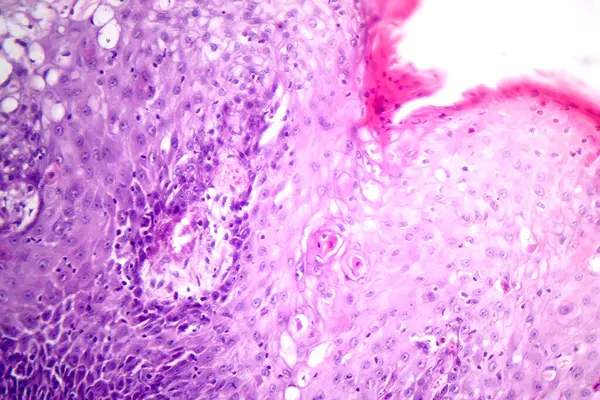 Fotomicrografia Carcinoma Mucinoso Estômago Exibindo Células Malignas Produtoras Mucina Característica — Fotografia de Stock