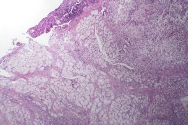 Midede Mukoza Kanserinin Fotomikroskobu Kötü Huylu Muksin Üreten Hücreler Gösteriyor — Stok fotoğraf