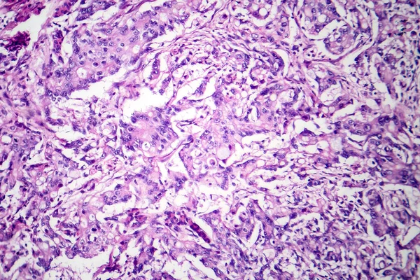 Photomicrograph of mucinous carcinoma in the stomach, displaying malignant mucin-producing cells, characteristic of an aggressive stomach cancer.