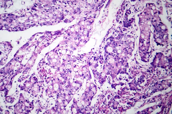 Photomicrograph of mucinous carcinoma in the stomach, displaying malignant mucin-producing cells, characteristic of an aggressive stomach cancer.