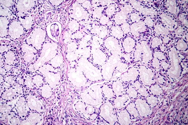 Fotomicrografía Carcinoma Mucinoso Estómago Mostrando Células Malignas Productoras Mucina Características — Foto de Stock