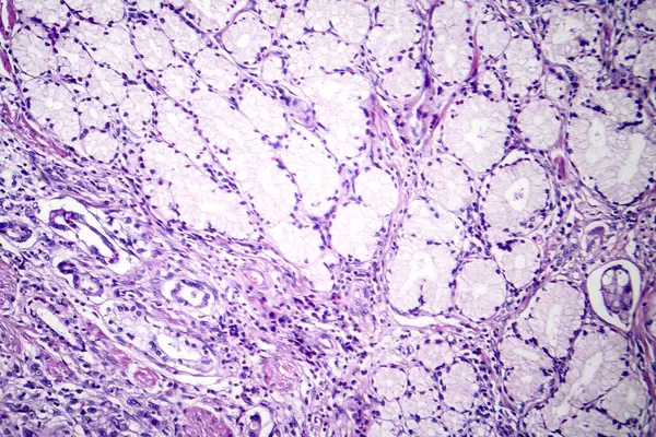Fotomicrografia Carcinoma Mucinoso Estômago Exibindo Células Malignas Produtoras Mucina Característica — Fotografia de Stock
