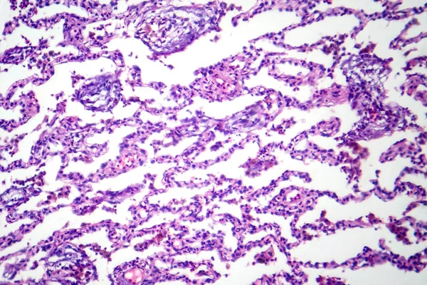 Photomicrograph Lobar Pneumonia Dissolved Dissipate Period Showing Resolving Inflammation Clearing — Stock Photo, Image