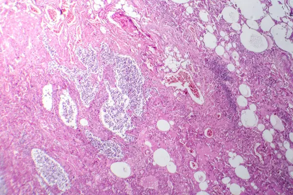 小細胞肺がんの光学グラフ 攻撃的な肺悪性の特徴を密に詰め込まれた悪性細胞を明らかにする — ストック写真
