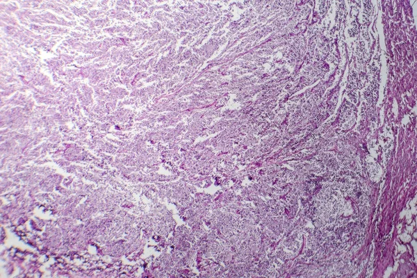 Fotomikrograf Drobnokomórkowego Raka Płuc Ujawniający Gęsto Zapakowane Komórki Nowotworowe Charakterystyczne — Zdjęcie stockowe