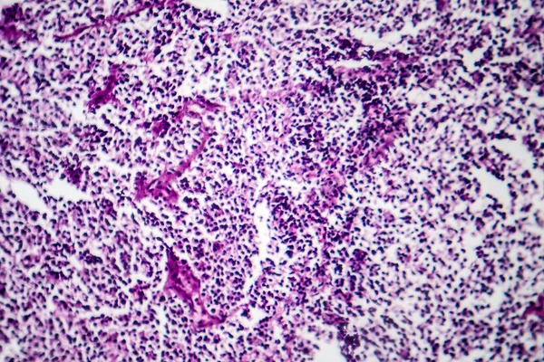 Photomicrograph Small Cell Lung Cancer Revealing Densely Packed Malignant Cells — Stock Photo, Image