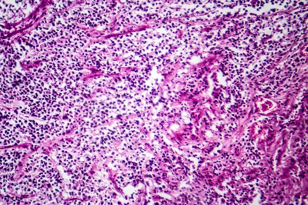 Photomicrograph of small cell lung cancer, revealing densely packed malignant cells characteristic of an aggressive lung malignancy.