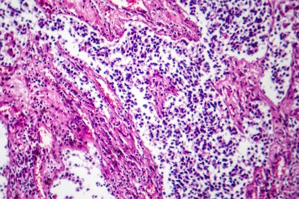 Photomicrograph of small cell lung cancer, revealing densely packed malignant cells characteristic of an aggressive lung malignancy.