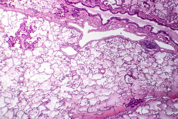 Фотомікрограф Аденокарциноми Легень Відображає Злоякісні Залозні Клітини Вказують Найпоширеніший Тип — стокове фото