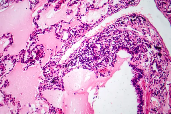 Tüdő Adenocarcinomájának Fotomikrográfja Amely Tüdőrák Leggyakoribb Típusára Utaló Rosszindulatú Mirigysejteket — Stock Fotó