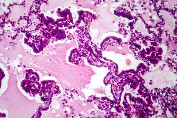 Fotomicrografia Dell Adenocarcinoma Polmonare Che Mostra Cellule Ghiandolari Maligne Indicative — Foto Stock