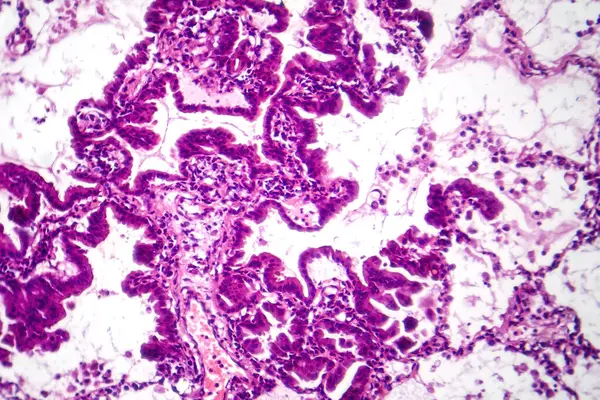 Photomicrograph of lung adenocarcinoma, displaying malignant glandular cells indicative of the most common type of lung cancer.