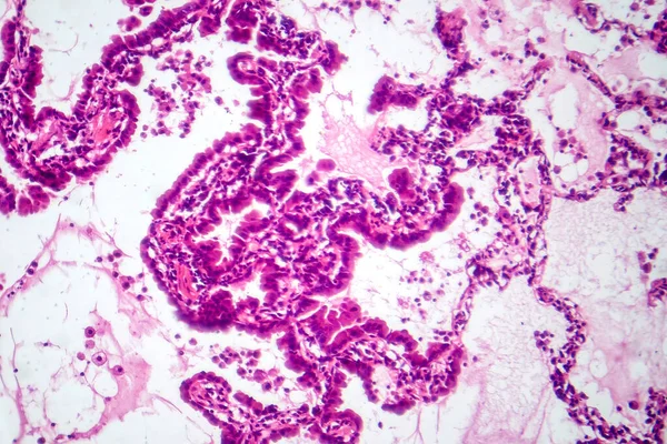 Fotomicrografía Del Adenocarcinoma Pulmón Que Muestra Células Glandulares Malignas Indicativas — Foto de Stock