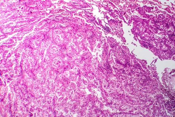 Fotomicrografia Tecido Câncer Pulmão Revelando Células Malignas Crescimento Anormal Característico — Fotografia de Stock