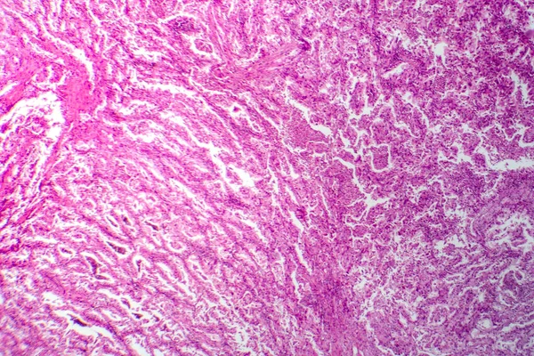 Fotografische Aufnahme Von Lungenkrebsgewebe Die Bösartige Zellen Und Das Abnorme — Stockfoto