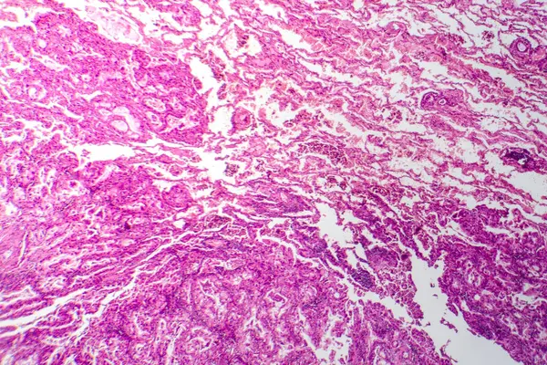 Photomicrograph of lung cancer tissue, revealing malignant cells and the abnormal growth characteristic of lung malignancy.