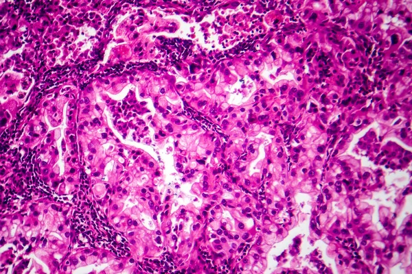 Fotomicrografia Tecido Câncer Pulmão Revelando Células Malignas Crescimento Anormal Característico — Fotografia de Stock