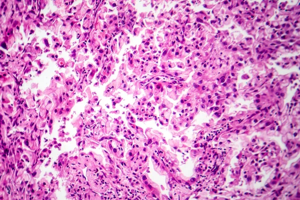 Photomicrograph Lung Cancer Tissue Revealing Malignant Cells Abnormal Growth Characteristic — Stock Photo, Image