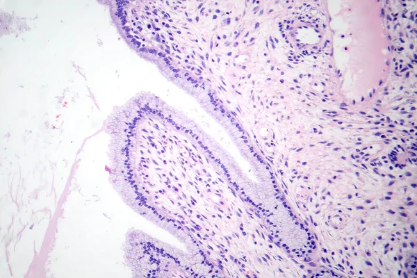 Photomicrograph Nasal Polyps Displaying Abnormal Tissue Growth Nasal Passages Often — Stock Photo, Image