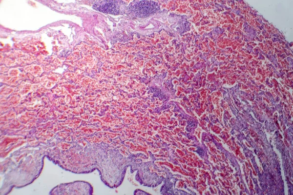 Photomicrograph Acute Pulmonary Hemorrhage Showing Blood Filled Alveoli Lung Tissue — Stock Photo, Image