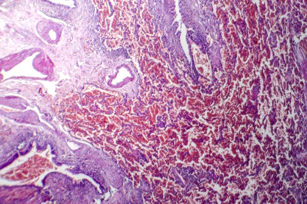 Fotomikrograf Akutního Plicního Krvácení Krví Naplněnými Alveolami Poškozením Plicní Tkáně — Stock fotografie