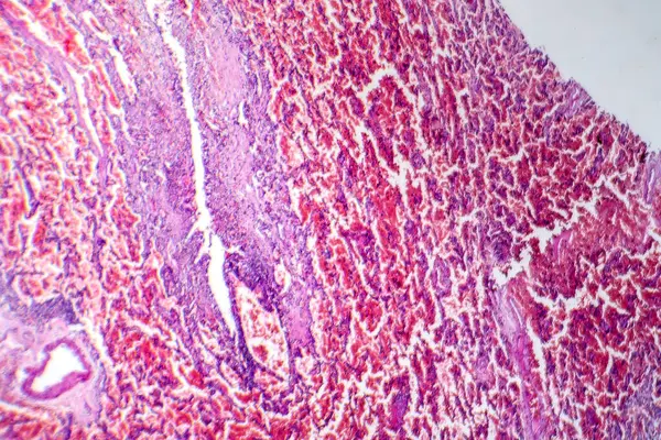 Photomicrograph Acute Pulmonary Hemorrhage Showing Blood Filled Alveoli Lung Tissue — Stock Photo, Image