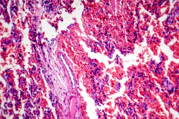 Fotomicrograaf Van Acute Pulmonale Bloeding Waaruit Bloed Gevulde Alveoli Longweefsel — Stockfoto