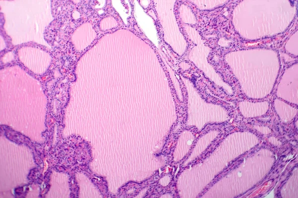 Fotomicrografia Uma Amostra Tecido Bócio Endémico Microscópio Revelando Anomalias Glândula — Fotografia de Stock