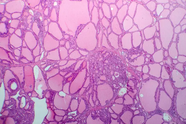 Fotografische Aufnahme Einer Toxischen Kropfgewebeprobe Unter Dem Mikroskop Die Eine — Stockfoto