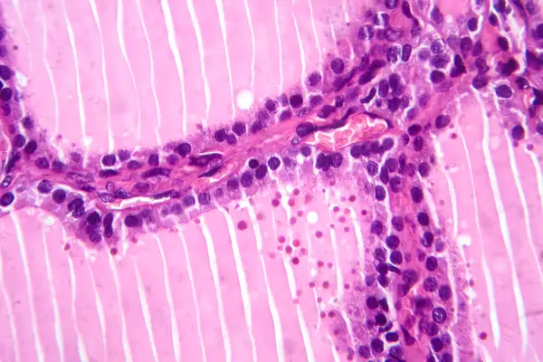 在显微镜下对一个有毒甲状腺肿组织样本的照相显微照片 显示甲状腺滤泡细胞肥大 血管增多 胶体损耗 — 图库照片