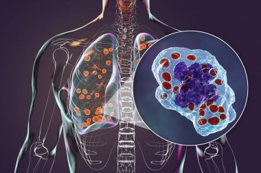 Akciğer histoplazmozu, Histoplasma kapsülünün sebep olduğu bir mantar enfeksiyonu. Akciğerlere dağılmış küçük nodüller ve akciğer makrofajlarının içindeki Histoplazma mayalarını gösteriyor..