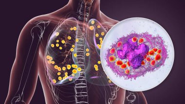 Akciğer histoplazmozu, Histoplasma kapsülünün sebep olduğu bir mantar enfeksiyonu. Akciğerlere dağılmış küçük nodüller ve akciğer makrofajlarının içindeki Histoplazma mayalarını gösteriyor..