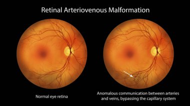 Retinal arteriovenöz malformasyon: retinadaki karışık kan damarları ile ender rastlanan retinal vasküler anomaliler, illüstrasyon kılcal damarlara müdahale edilmeden arter damarı iletişimini gösteriyor.