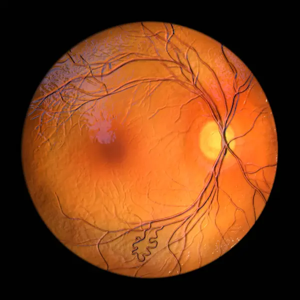 Retinal Arteriovenous Malformation Rare Congenital Retinal Vascular Anomalies Tangled Blood — Stock Photo, Image