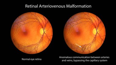 Retinal arteriovenöz malformasyon: retinadaki karışık kan damarlarında nadir rastlanan retinal damar anomalileri, üç boyutlu illüstrasyon kılcal damarlara müdahale edilmeden arter-damar iletişimini gösteriyor.