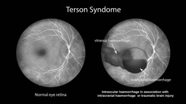 Terson sendromunu gösteren tıbbi bir illüstrasyon florasan anjiyografisi sırasında gözlemlenen ve kafa içi kanama ya da travmatik beyin hasarıyla bağlantılı olduğunu gösteriyor..