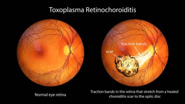 Optalmoskopi sırasında görülen Toxoplasma retinokoroiditi tasvir eden 3 boyutlu bir illüstrasyon, iyileşmiş bir yaradan optik diske uzanan çekiş bantları gösteriyor.