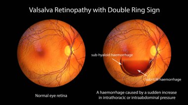 Optalmoskopi sırasında gözlemlenen Valsalva retinopatisinin 3 boyutlu bir çizimi, çift halka işaretli gözaltı basıncındaki ani artıştan kaynaklanan retinal kanamalar gösteriyor..