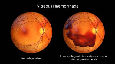 Optalmoskopi sırasında gözlemlenen vitröz kanamayı gösteren 3 boyutlu tıbbi bir illüstrasyon, retinal ayrıntıları gizleyen vitröz mizah içindeki kanı ortaya çıkarıyor..