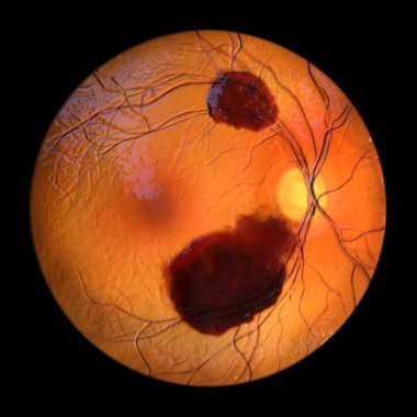 Göz muayenesi sırasında gözlenen üç boyutlu bir iç kanama, retina katmanlarının altında koyu ve düzensiz bir kanama olduğunu gösteriyor..