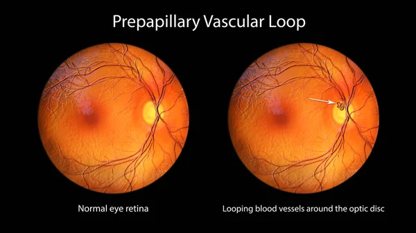视网膜上的乳头状血管环 如在眼底镜检查时观察到的 三维图片说明了视盘周围的环状血管 — 图库照片