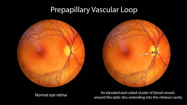 眼視鏡検査中に観察された網膜上の先行細胞ループ 3Dイラストは 視覚ディスクの周りのループ血管を示しています — ストック写真