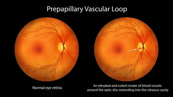 Uma Alça Vascular Pré Papilar Retina Como Observado Durante Oftalmoscopia — Fotografia de Stock